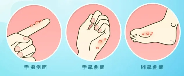 脚上怎样分辨是湿疹还是脚气（脚上怎么分辨是湿疹还是疱疹）