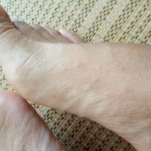 脚上起小水泡很痒是什么原因（脚上起小水泡很痒的原因）
